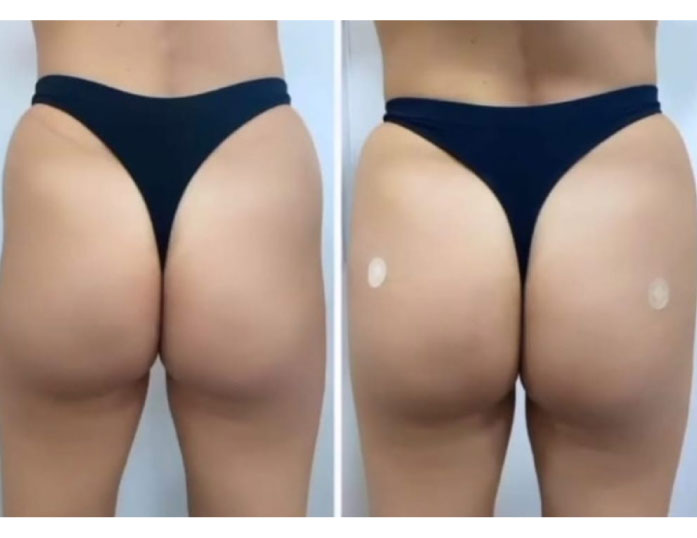 antes-bumbum
