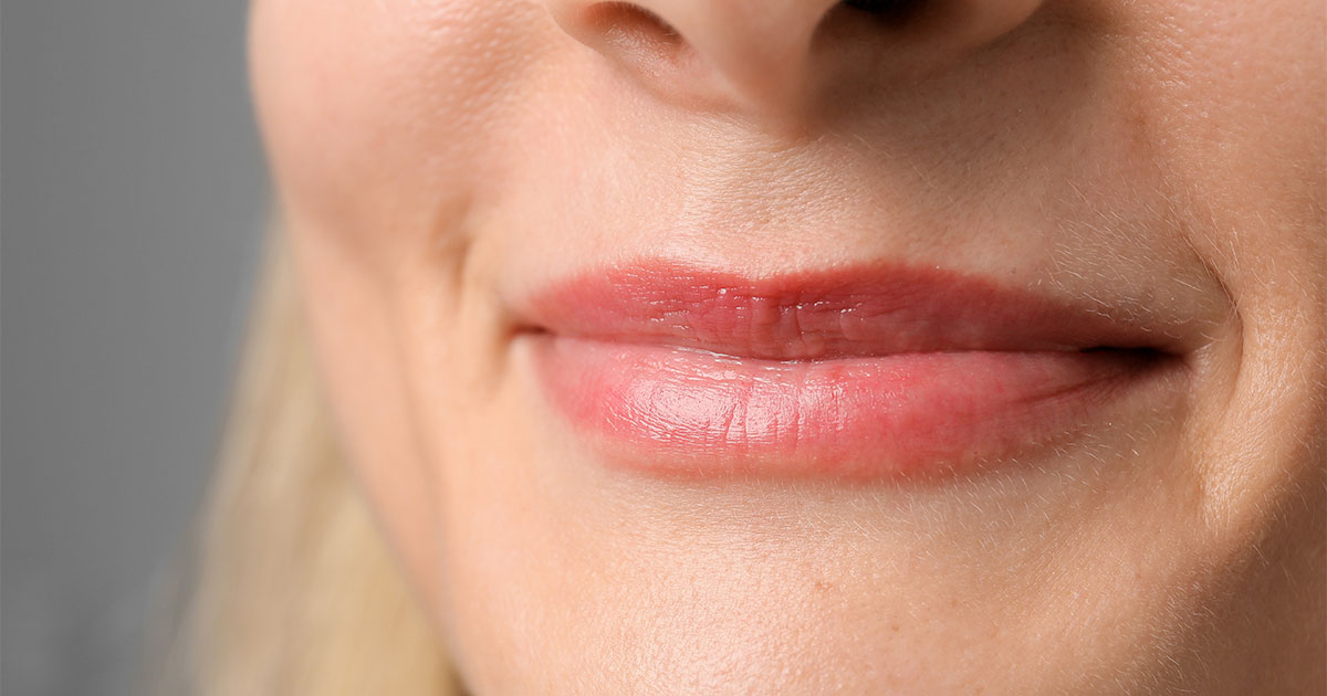 Preenchimento labial natural no Instituto VA em Joinville