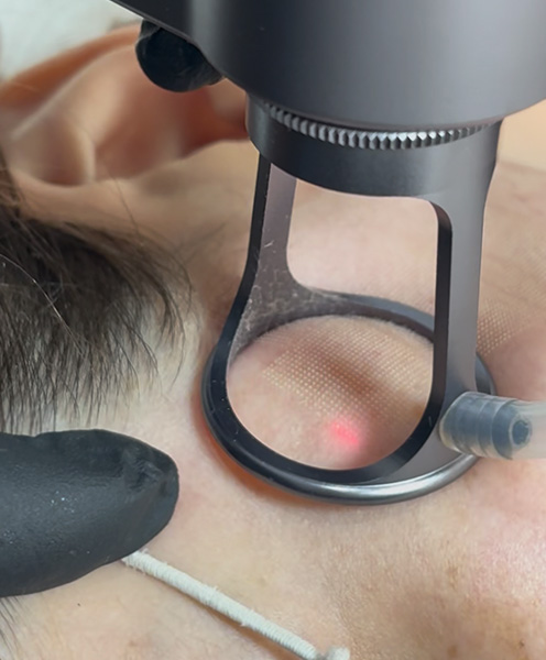 Laser Co2 Fracionado em Joinville