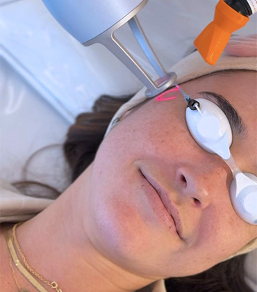 Tratamentos faciais com lasers co2, lavieen e lasers estéticos em Joinville.