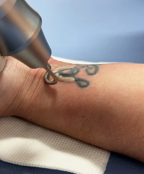 Remoção de Tatuagemem Joinville