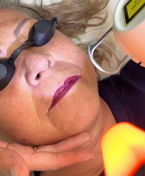 Lasers estética facial