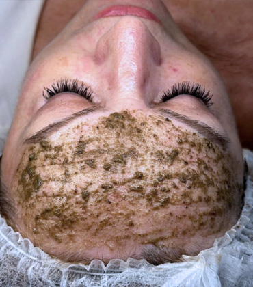 Sempre Jovem, conheça os procedimentos faciais que fazem parte desta jornada de transformação facial.