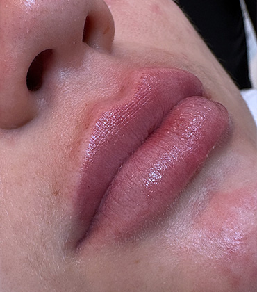 Preenchimento labial natural em Joinville, clínica Instituto VA.
