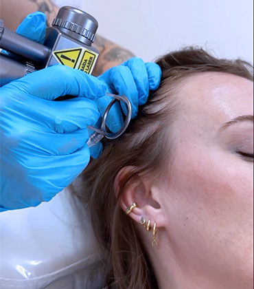 Conheça o tratamento capilar com lasers e injetaveis do Instituto VA em Joinville.