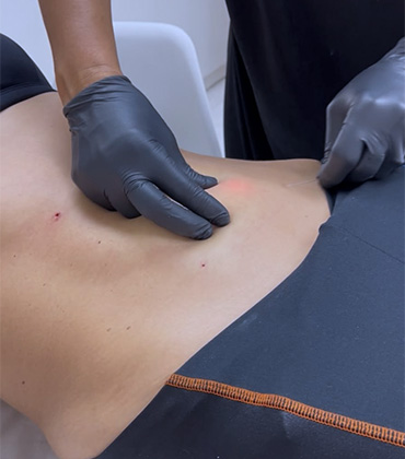 Xo Flacidez tem o procedimento de endolift para reduzir gordura e flacidez, conheça o metodo VA em Joinville.