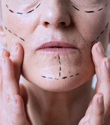 Conheça o Xo Flacidez, protocolo estético com procedimentos para reduzir flacidez facial.