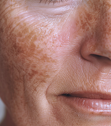 Tratamento para melasma facial e colo, conheça a clínica Instutito VA em joinville.