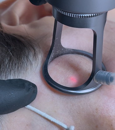 Xo Melasma é um tratamento exclusivo para manchas na pele e na face, conheça o protocolo completo.